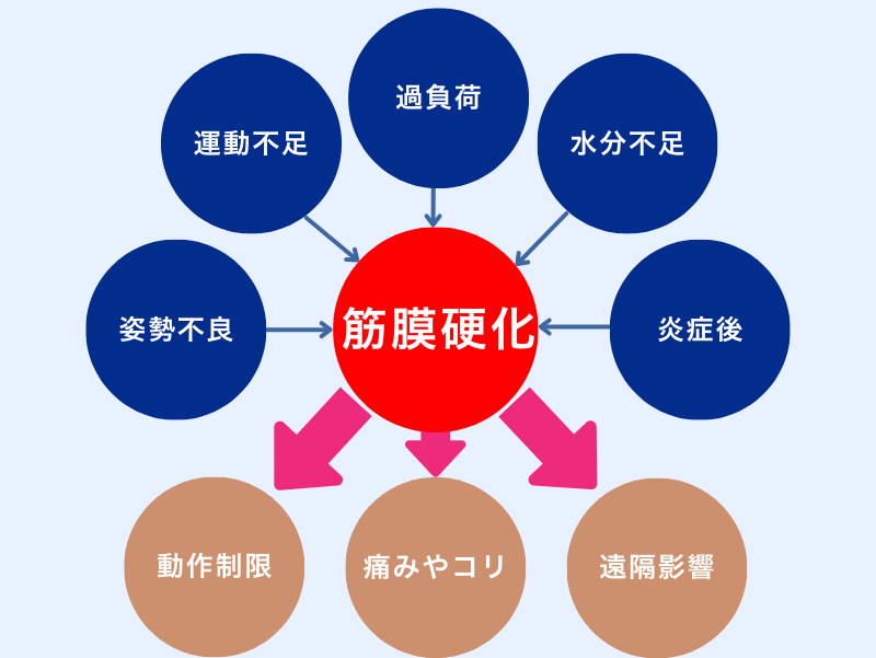 筋膜が硬くなる原因マップ：姿勢不良、運動不足、過負荷、水分不足、炎症後などが重なると滑走性が低下